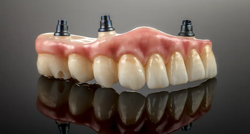 A full upper denture carried on three titanium implant abutments, its pink acrylic gum line and full set of teeth seen from the front on a dark reflective surface — illustrative example