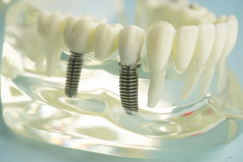 A clear resin lower-jaw model with two separate titanium implants set in the arch, one carrying a crown, the roots of the natural teeth visible through the resin — illustrative example