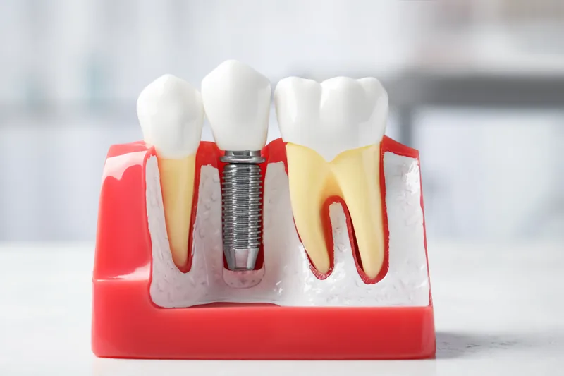 A close view of a sectioned dental model showing a single titanium implant in bone carrying a crown, with a natural tooth root on one side and a sectioned molar on the other — illustrative example