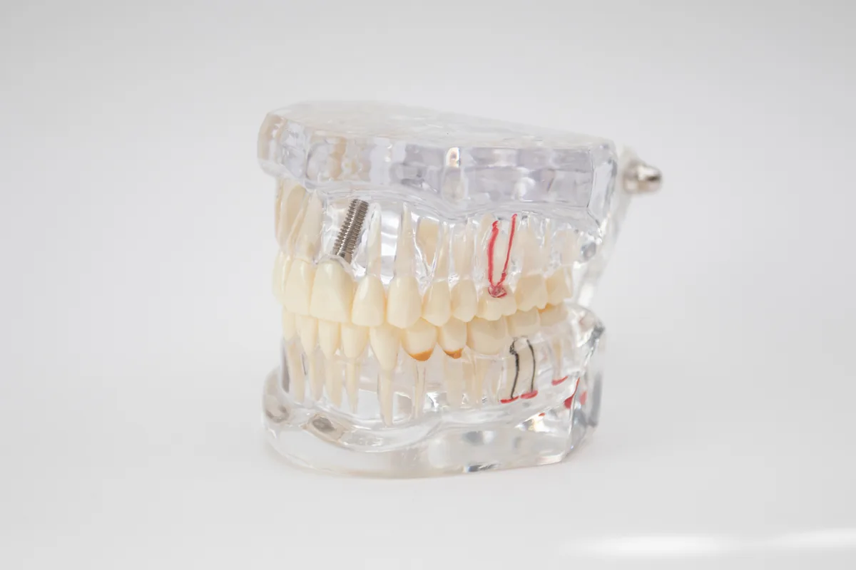 A clear dental teaching model of both jaws on a plain background, a single titanium implant standing in the upper arch where a natural tooth root would sit, the roots of the surrounding teeth visible through the resin — illustrative example